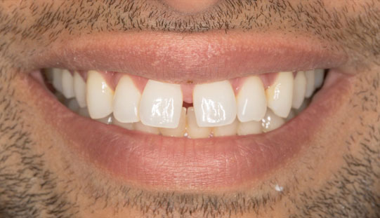 example before dental orthodontic treatment