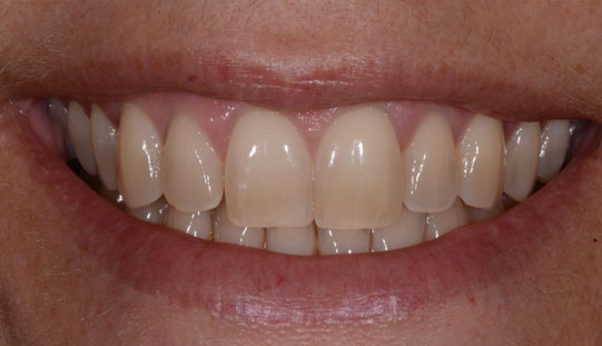 example before dental orthodontic treatment