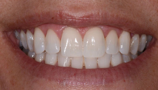 example after dental orthodontic treatment