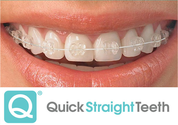 quick straight teeth dentist Glasgow